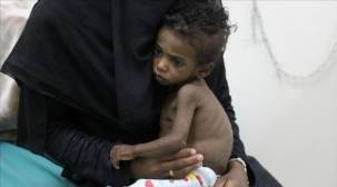 الصحة العالمية: عدد وفيات وباء الكوليرا يتجاوز 713 حالة في اليمن