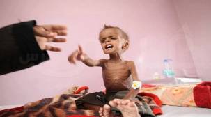 سوء التغذية يهدد جيل كامل من أطفال اليمن