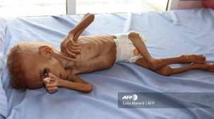 برنامج الغذاء العالمي: ملاييين اليمنيين وخاصة الاطفال يعانون من الجوع