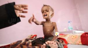 الصحة العالمية: حوالي 400 ألف طفل يمني يعانون من سوء التغذية الحاد