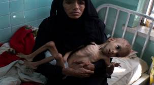 المجاعة .. عنوان اليمن الأبرز خلال عام 2018