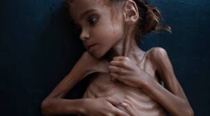 أمل اليمنية التي أبكت صورتها العالم تموت بالجوع والمرض
