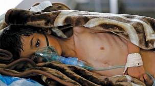 اليونيسف: نحو 380 ألف طفل يمني يعانون من سوء التغذية الحاد