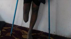 أحد ضحايا ألغام الحوثيين