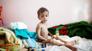اليونيسيف: أكثر من 460 ألف طفل يمني يعانون سوء تغذية حاد